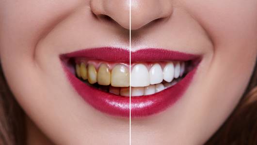 Чим професійні методи відбілювання зубів кращі за домашні засоби?