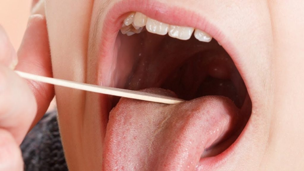 Ангіна у дорослих: види, симптоми та способи лікування