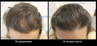 Міноксидил - Які переваги міноксидилу для волосся?