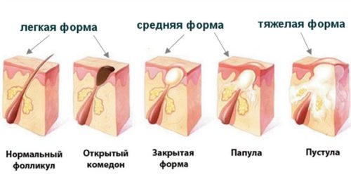 Прищі на шкірі голови - Як вилікувати прищі на шкірі голови?