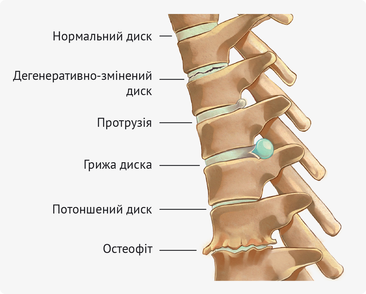 Звідки береться грижа хребта і що з нею робити